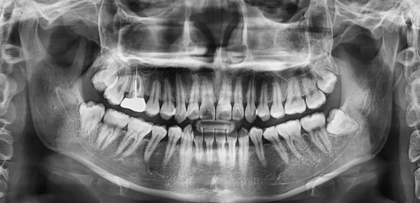 Кому может понадобиться ортопантомограмма зубов
