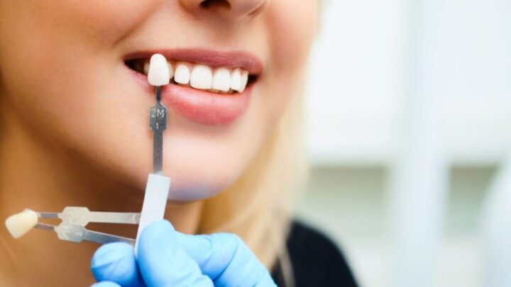 Що зараз модно у косметичній стоматології?