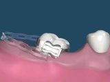 Микроимпланты в ортодонтии: современные возможности для идеального улучшения улыбки